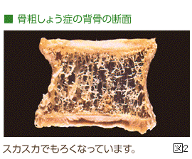骨密度検査