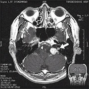 左聴神経腫瘍