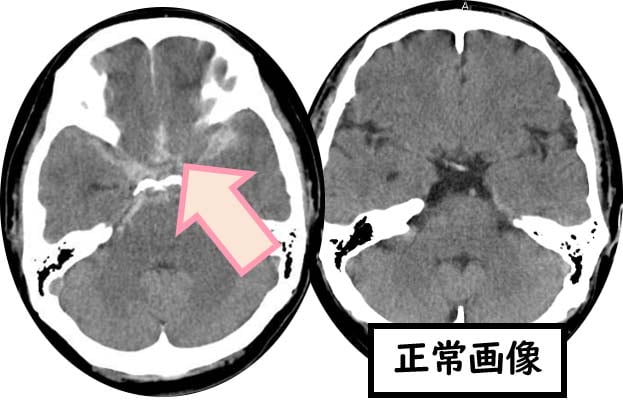 くも膜下出血