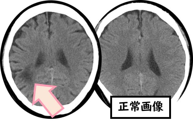 脳梗塞